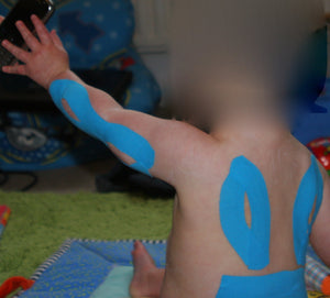 Kinesio Taping® in Paediatrics