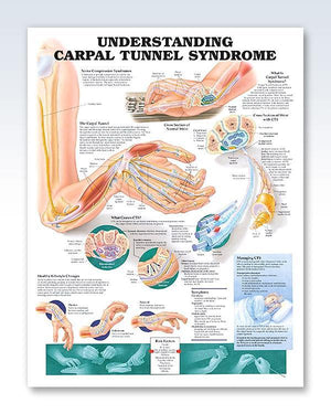 Carpal Tunnel Syndrome Poster